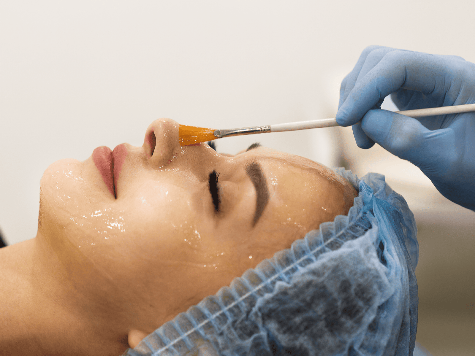 Chemical Peels