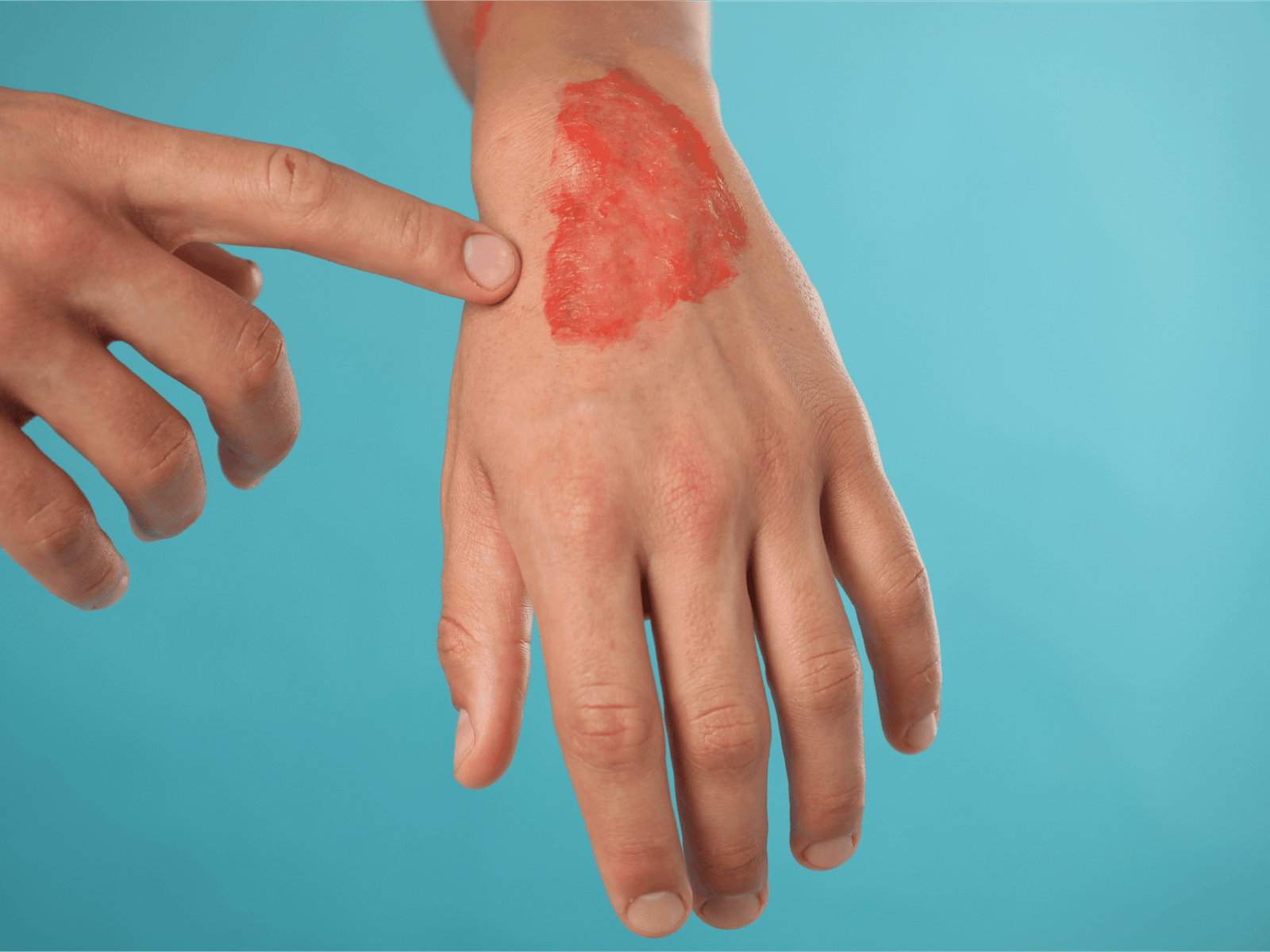 Burns & Burn Contractures