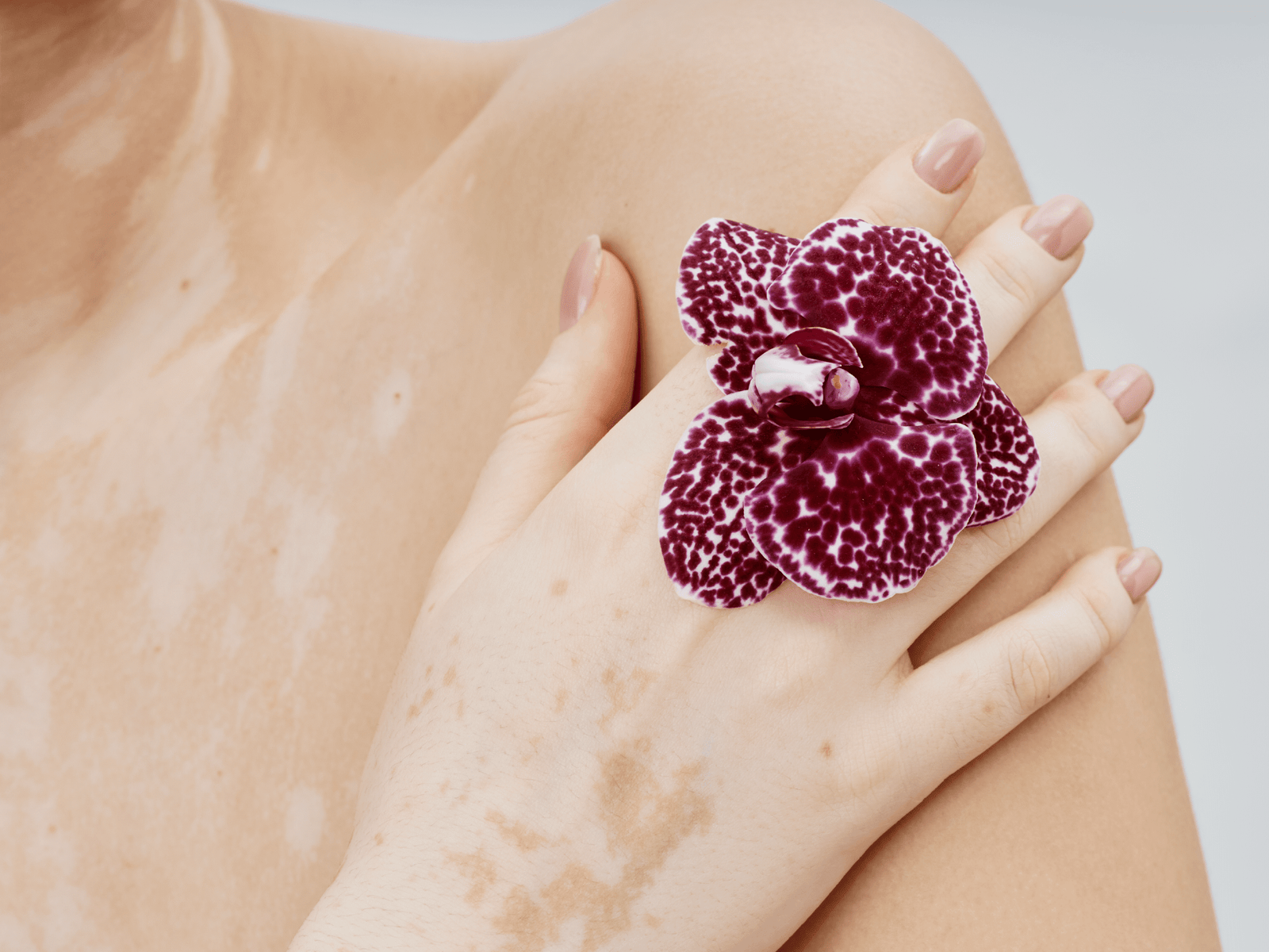Vitiligo / Leukoderma