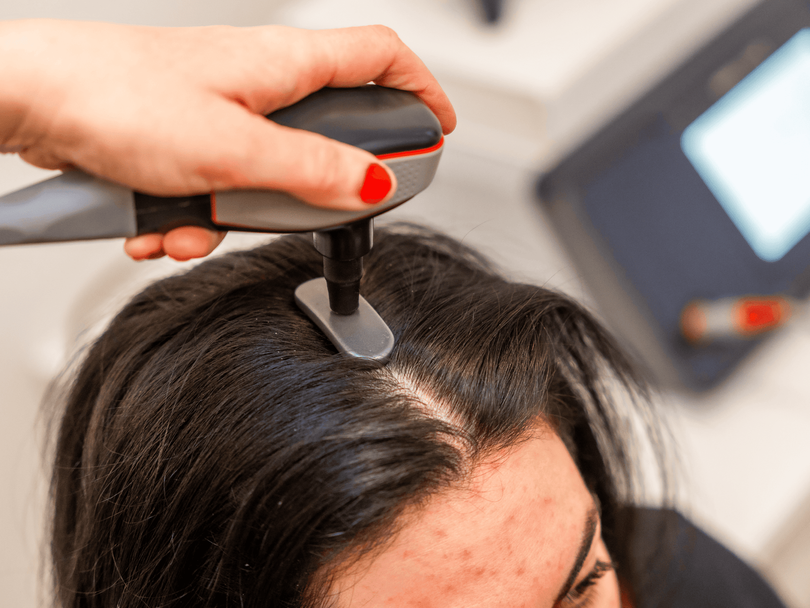 Hair-loss Treatment